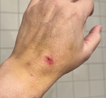 Dog bite marks and bruising on the back of a hand.