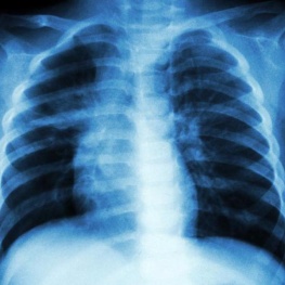 Pulmonary TB x-ray