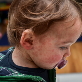 A toddler has a rash from measles